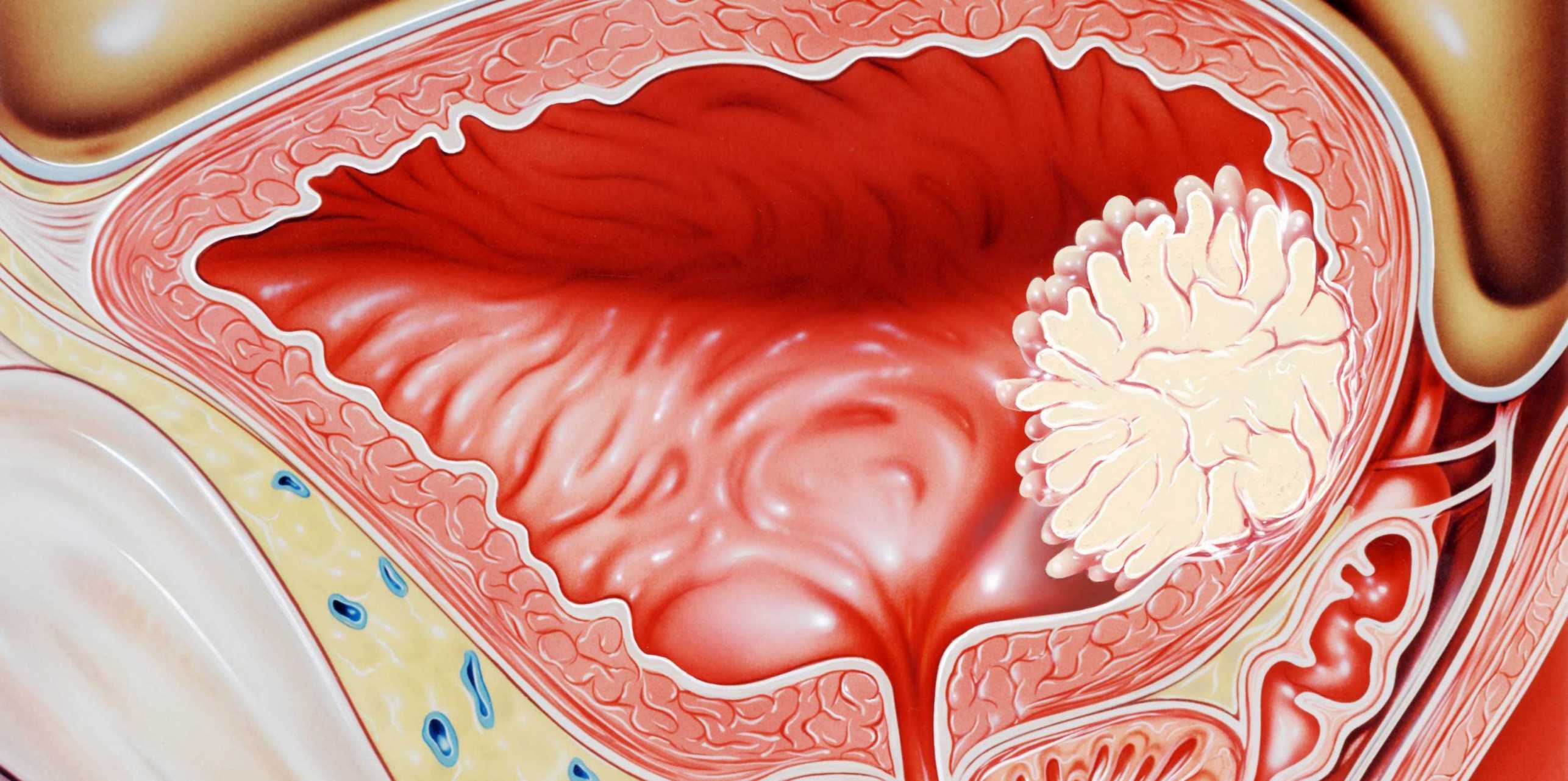 Graphic of papillary tumor, which grows from the bladder wall into the bladder cavity