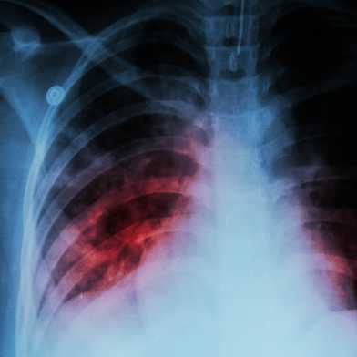 Lung-infected_Tuberculosis