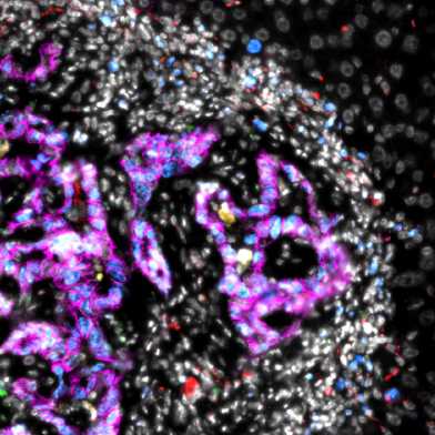 colorectal - mestastasis -microscopy image