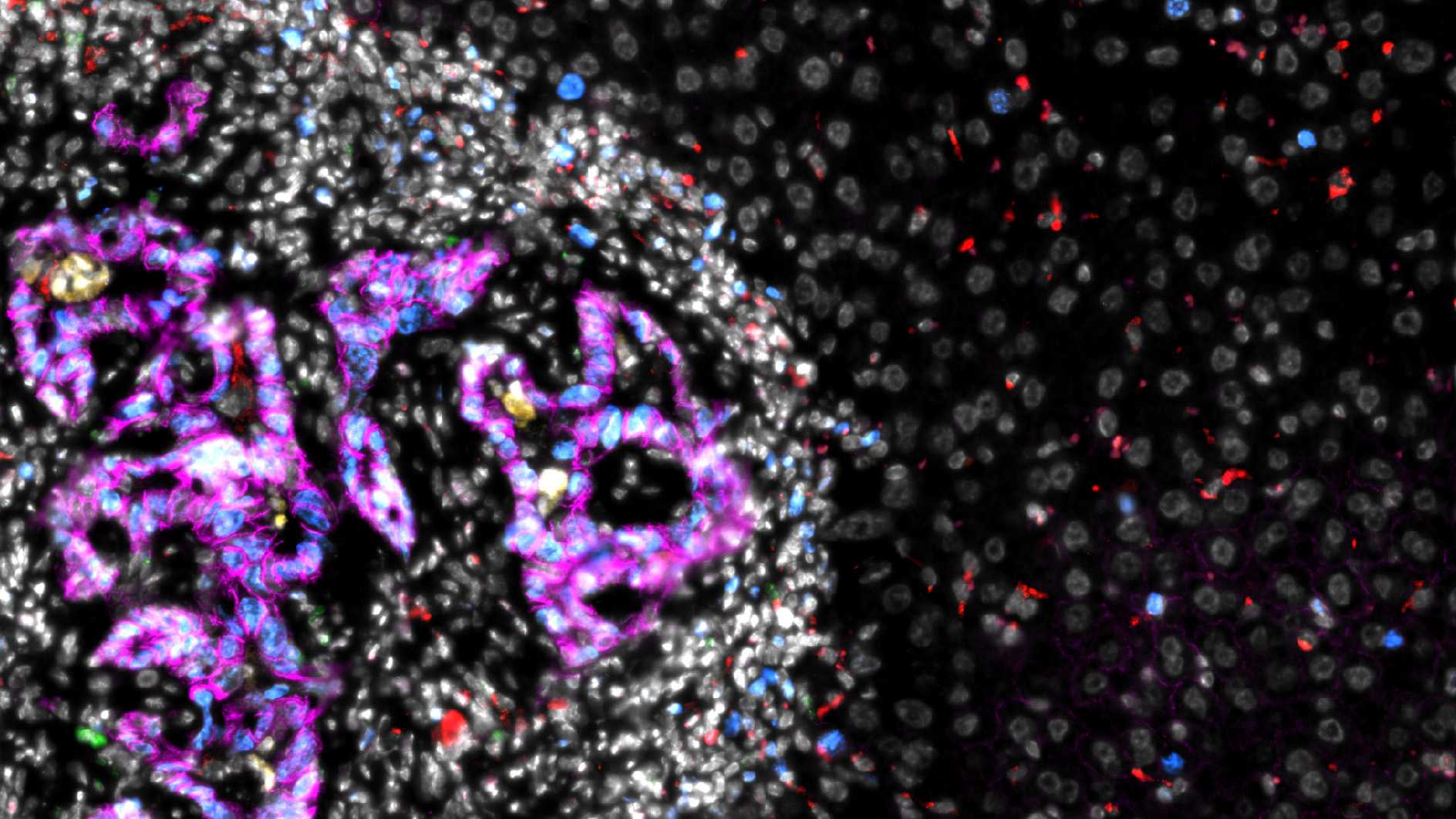 colorectal - mestastasis -microscopy image